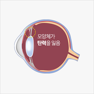 모양체노화안구
