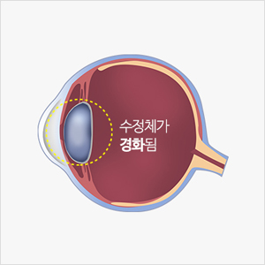 수정체가 노화된 안구